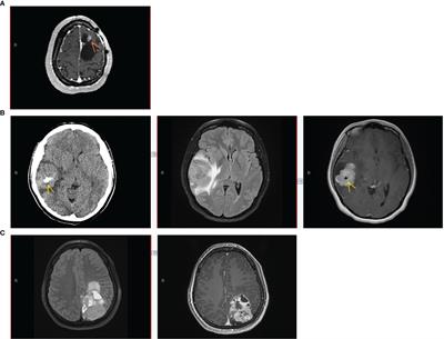 Heterogeneous clinicopathological findings and patient-reported outcomes in adults with <mark class="highlighted">MN1</mark>-altered CNS tumors: A case report and systematic literature review